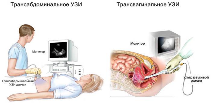 Виды УЗИ малого таза у женщин