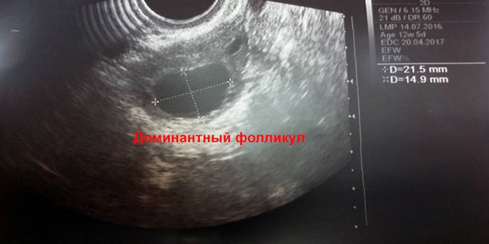 Доминантный фолликул 