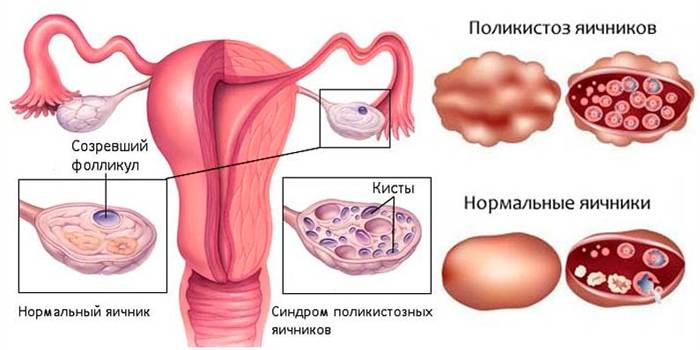 Синдром поликистозных яичников