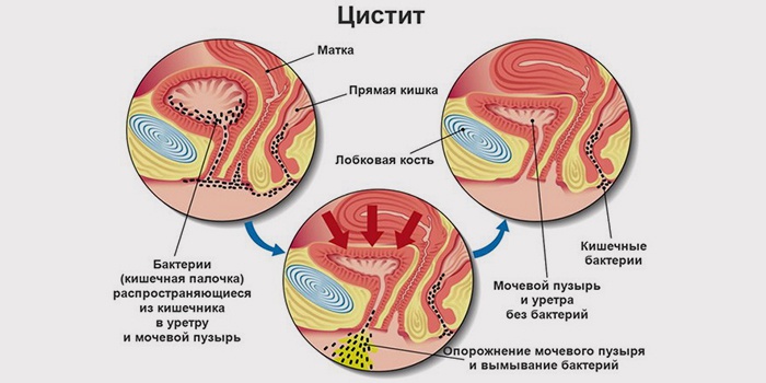 Причины появления цистита