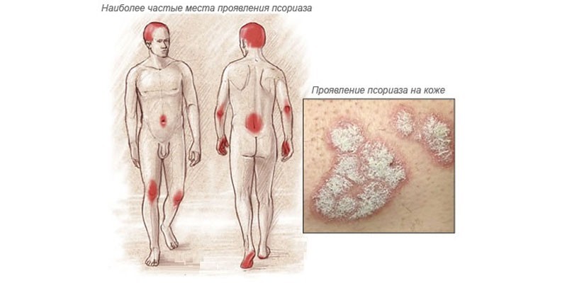 Наиболее частые места появления псориаза на коже