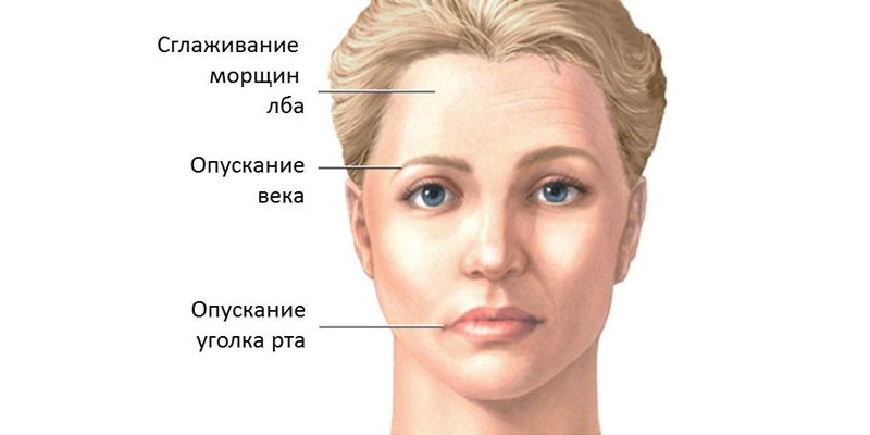 Невралгия тройничного нерва