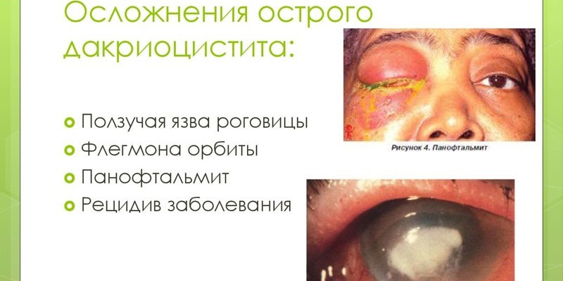 Осложнения дакриоцистита