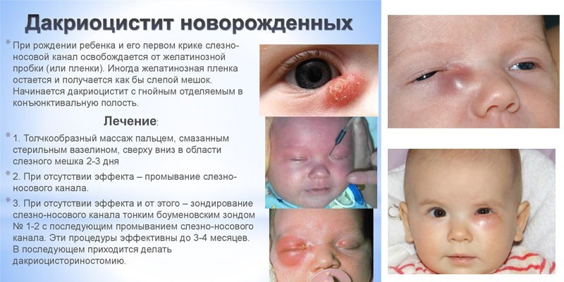 Дакриоцистит у новорожденных
