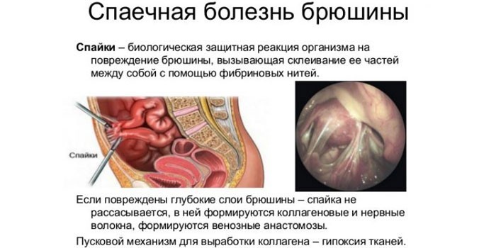 Спайки в кишечнике