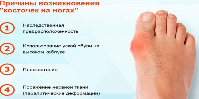 Причины артрита стопы
