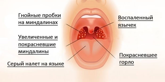 Симптомы абсцесса горла