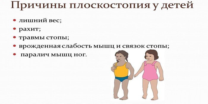Причины плоскостопия у детей