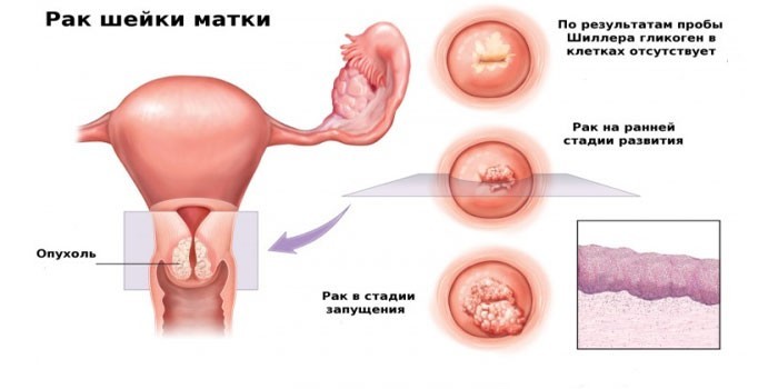Рак шейки матки