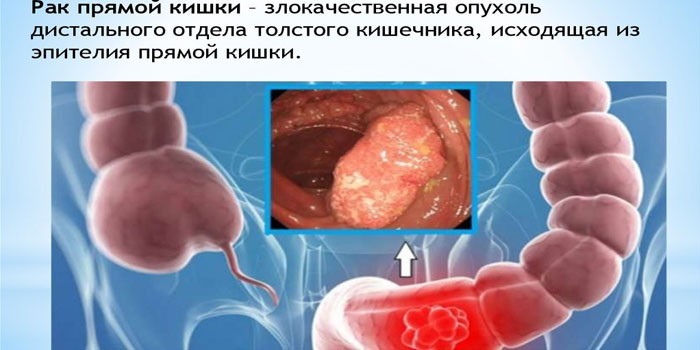 Раковая опухоль прямой кишки