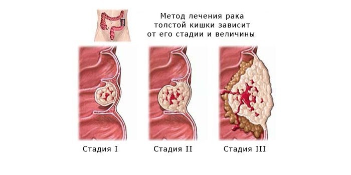 Стадии рака прямой кишки