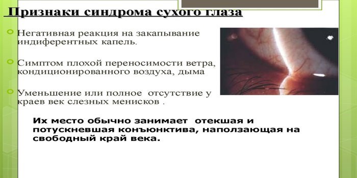 Признаки сухого глаза