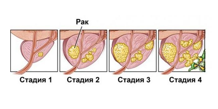 Стадии развития рака простаты