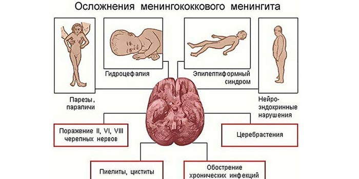 Возможные осложнения менингита у детей