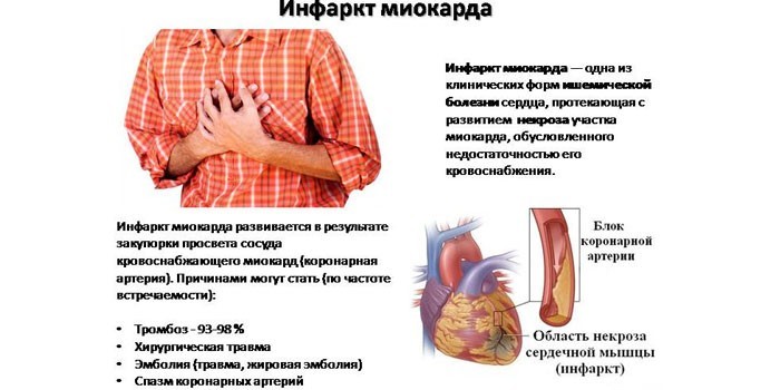 Симптомы и причины возникновения инфаркта миокарда