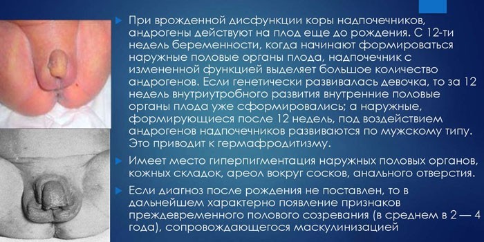 Адреногенитальный синдром у новорожденного