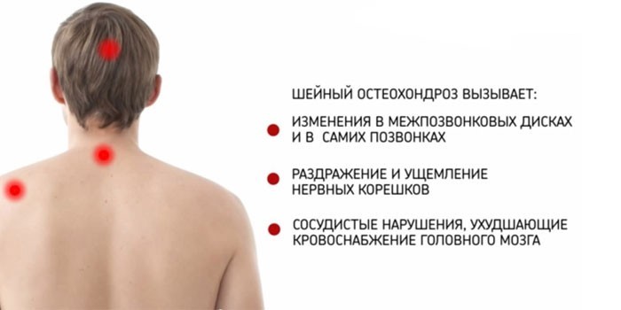 Осложнения остеохондроза шейного отдела позвоночника