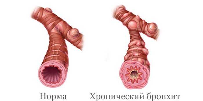 Бронхи в норме и при хроническом бронхите