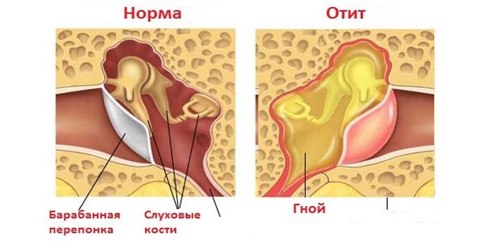 Ухо в норме и гнойный отит