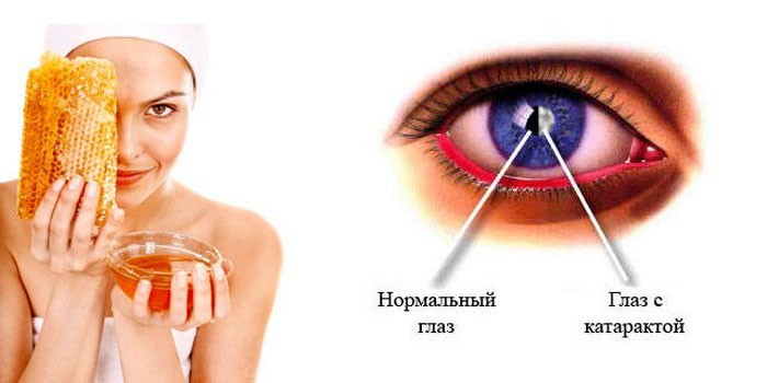 Мед и катаракта глаза