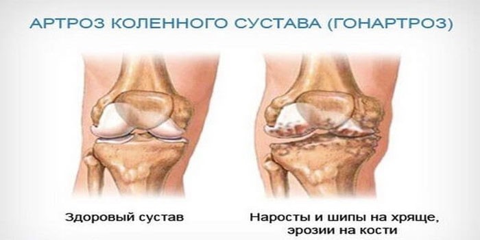 Артроз коленного сустава