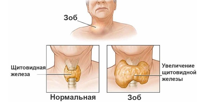 Зоб щитовидной железы