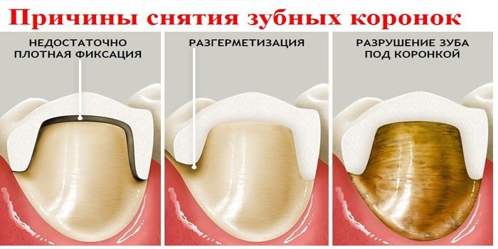 Снятие коронки 