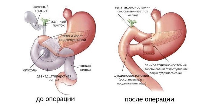 Суть панкреатодуоденальной резекции