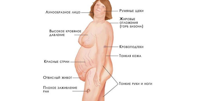 Проявления кортикостеромы