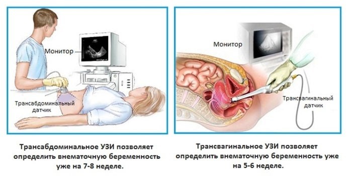 Диагностика внематочной беременности