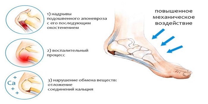 Причины болевых ощущений при ходьбе