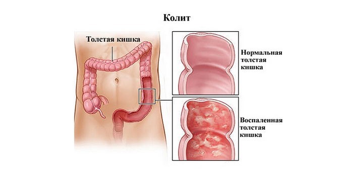 Причины колита