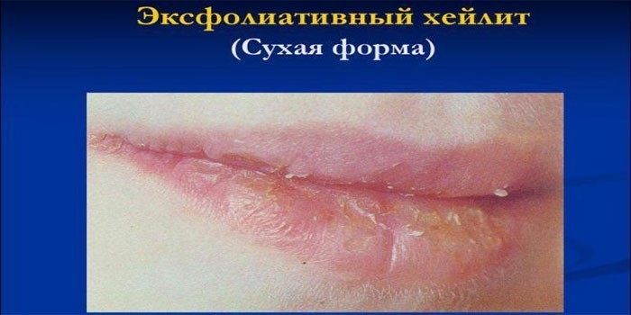 Эксфолиативный хейлит