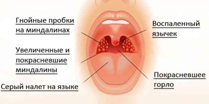 Показания для приема антибиотиков от горла