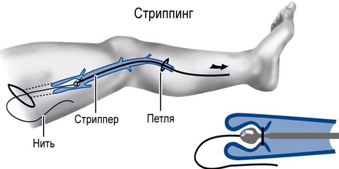 Стриппинг вен
