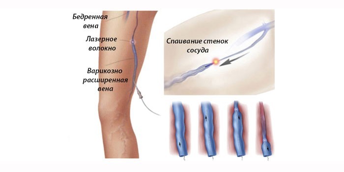 Спаивание стенок сосудов лазером