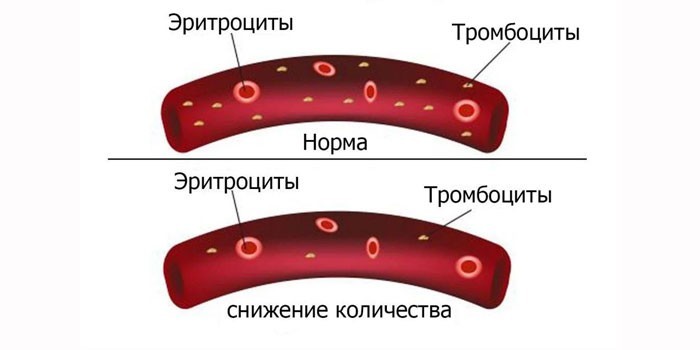Формы тромбоцитопении