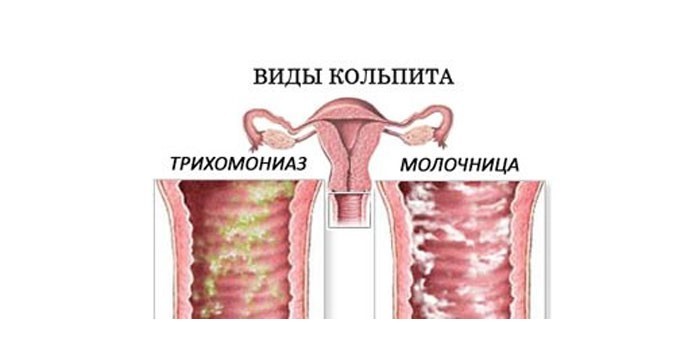 Трихомониаз и молочница