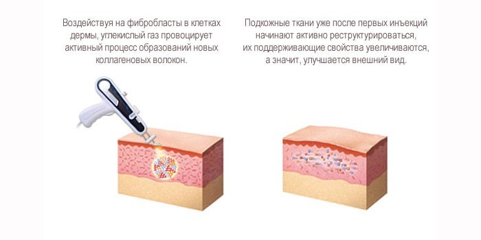 Действие газовых уколов