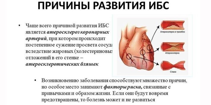 Причины развития ИБС