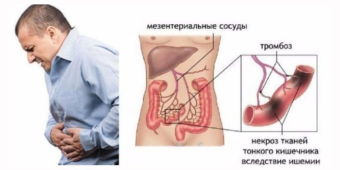 Ишемии кишечника