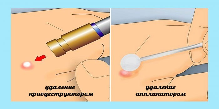 Удаление методом криодеструкцией или аппликатором