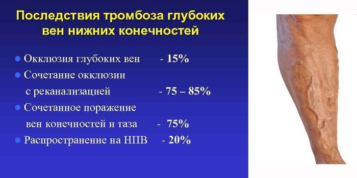 Последствия тромбоза глубоких вен