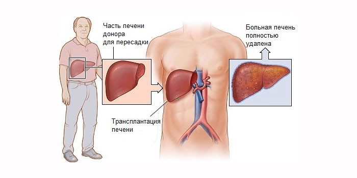 Как проводят операцию