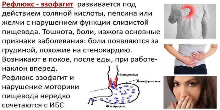 Симптомы и причины рефлюкс-эзофагита