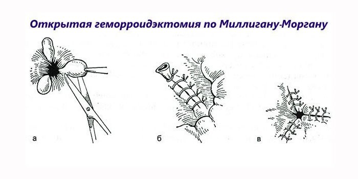 Техника операции по Миллигану-Моргану