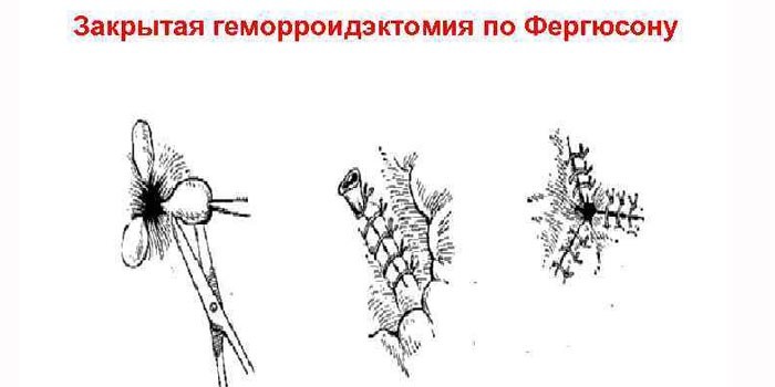 Удаление геморроя по Фергюсону