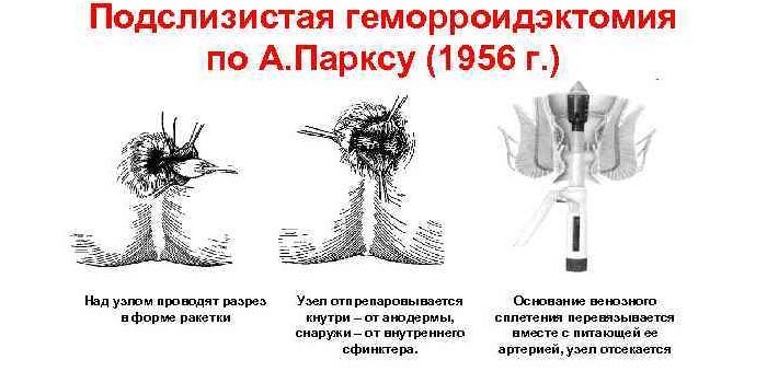 Подслизистая геморроидэктомия по Парксу