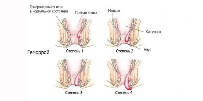 Стадии геморроя