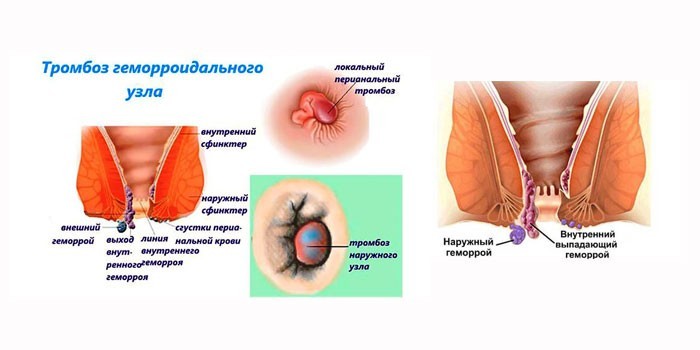 Тромбоз геморроидального узла